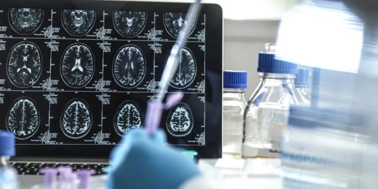 Estudo sugere que forma muito rara de Alzheimer pode ser transmissível