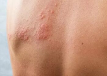 Herpes zoster: saiba quem tem mais chances de desenvolver a doença