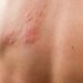 Herpes zoster: saiba quem tem mais chances de desenvolver a doença