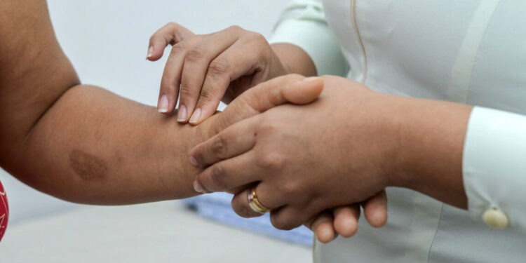 Saúde abre inscrições para o 1° Seminário de Hanseníase do Tocantins