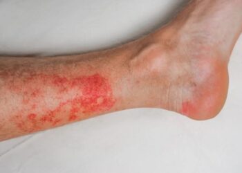 Erisipela é mais comum nos membros inferiores, como pernas e pés, segundo a Sociedade Brasileira de Dermatologia Evgeniya Sheydt/GettyImages