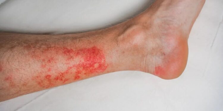 Erisipela: o que é, sintomas e principais formas de tratamento