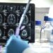Genes que aumentam risco de Alzheimer podem ser herdados, diz estudo