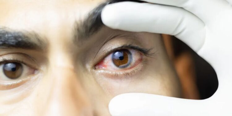 Novo método de terapia fotodinâmica pode erradicar o melanoma ocular, diz estudo