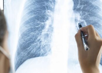 Médica analisa exame de Raio X de pulmão Virojt Changyencham/Getty Images