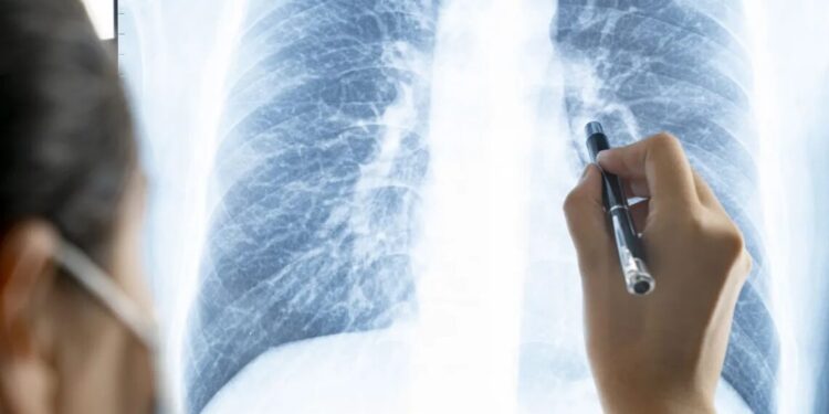 Covid-19: risco para pulmões pode persistir por anos após infecção grave