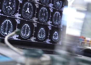 Hematoma subdural é uma condição caracterizada pelo acúmulo de sangue no cérebro e é causado por traumas decorrentes de quedas, acidente de carro ou golpes na cabeça Andrew Brookes/GettyImages