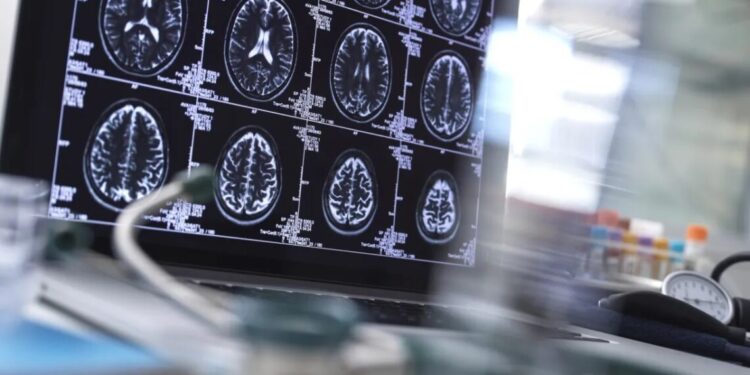 O que é hematoma subdural e como é feito o tratamento