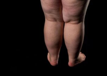 Lipedema é caracterizado pelo acúmulo irregular de gordura no corpo
Motortion/Getty Images