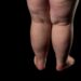 O que causa lipedema? Conheça sintomas e tratamentos para a doença