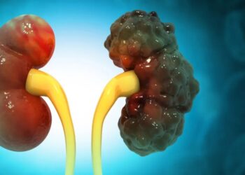 Ilustração mostra como pode ficar um rim policístico
Mohammed Haneefa Nizamudeen/Getty Images