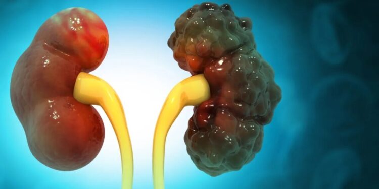 O que é rim policístico, doença genética do cantor Chrystian