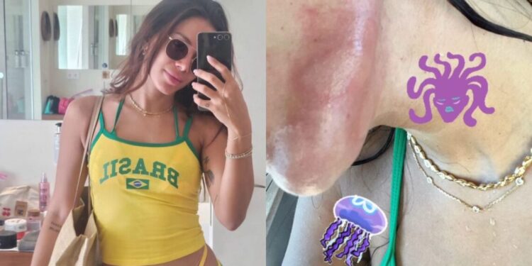 Anitta é queimada por água-viva em Ibiza: “Dor que nunca senti na vida”