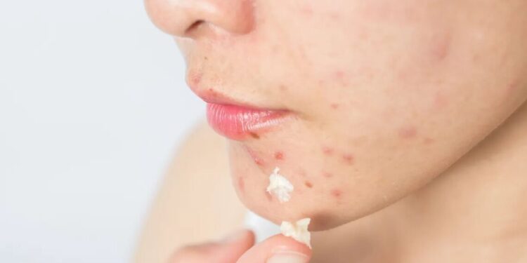 O que causa acne? Saiba como prevenir e conheça os principais tratamentos