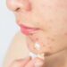 O que causa acne? Saiba como prevenir e conheça os principais tratamentos