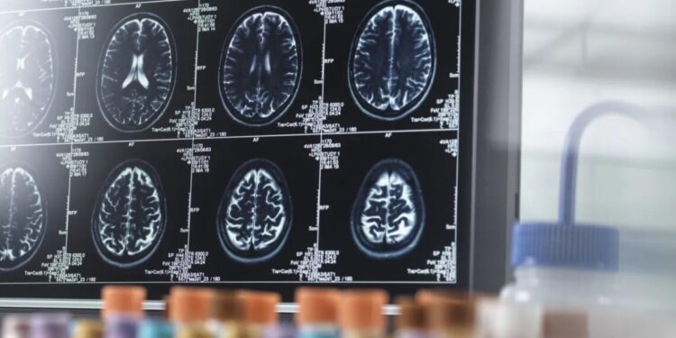 IA pode ajudar a prever avanço dos sintomas de Alzheimer, mostra estudo