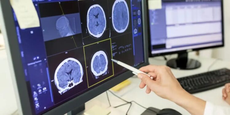 Estudo descobriu que a Covid-19 e a esquizofrenia podem afetar o cérebro de formas semelhantes
Luis Alvarez/Getty Images