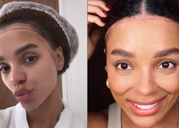 Procedimento foi feito há dois meses, quando Brunna documentou o processo de sua internação Instagram/Brunna Gonçalves