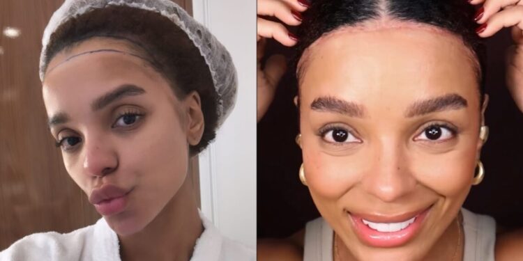 Brunna Gonçalves mostra resultado de cirurgia na testa: “Mudou minha vida”