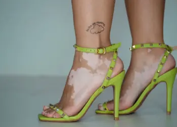 Para aumentar a conscientização, apoiar, educar e combater a desinformação sobre o vitiligo instituiu-se uma data comemorativa no Brasil. Fotógrafa: Stefany Lins.