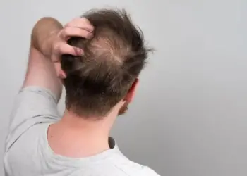 Estima-se que 50% dos homens experimentarão algum grau de calvície até os 50 anos de idade
Banco de imagens/Shutterstock