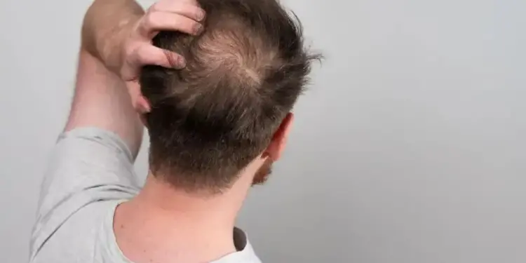 Estima-se que 50% dos homens experimentarão algum grau de calvície até os 50 anos de idade
Banco de imagens/Shutterstock