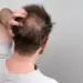 Minoxidil, finasterida e outros: benefícios e riscos de medicamentos contra a calvície