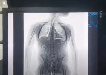 Exame para identificar drogas no estômago de passageiro em aeroporto PF