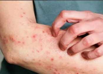 Eczema é um tipo de doença de pele que, segundo virologista da Mayo Clinic, pode aumentar risco de infecção grave por mpox • Kinga Krzeminska/GettyImages