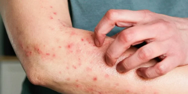 Mpox: eczema na pele pode agravar infecção, diz virologista