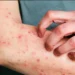Mpox: eczema na pele pode agravar infecção, diz virologista