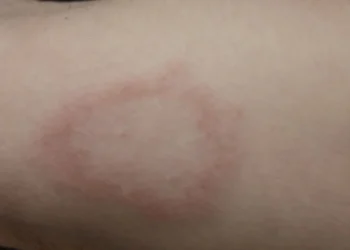 Hanseníase pode provocar lesões graves na pele e nos nervos • Ricardo Bhering/AI4Leprosy