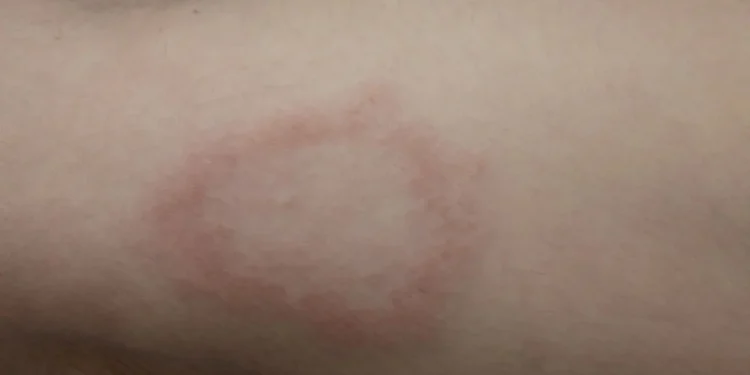 Hanseníase: veja sintomas e diagnóstico da doença que tem vacina em estudo