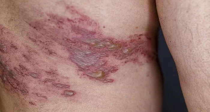 Herpes-zóster: quem deve tomar vacina contra a doença?