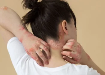Psoríase: o que é, quais são os sintomas, tratamentos e prevenção