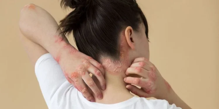 Psoríase: o que é, quais são os sintomas, tratamentos e prevenção