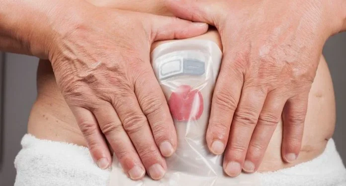 No Dia Nacional dos Ostomizados, SES-TO conscientiza contra o preconceito