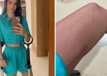 Vera Viel mostra recuperação da perna esquerda após retirada de tumor • Instagram/Vera Viel