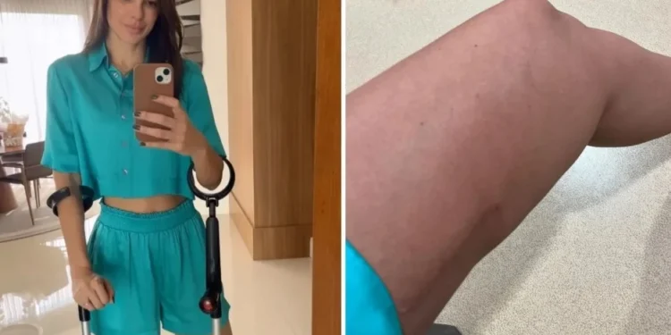 Vera Viel mostra recuperação da perna após cirurgia de câncer