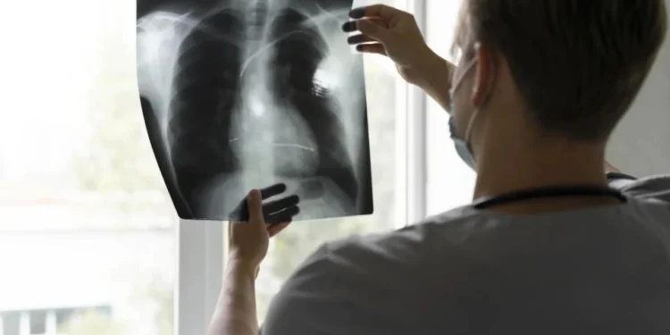 Anvisa aprovou nova indicação para imunoterapia em novembro, aumentando as opções de tratamento para pacientes com câncer de pulmão agressivo • Freepik