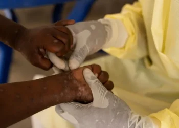 Enfermeira coleta amostra de criança com suspeita de infecção por mpox no território de Nyiragongo, perto de Goma, na província de Kivu do Norte, na República Democrática do Congo • REUTERS/Arlette Bashizi