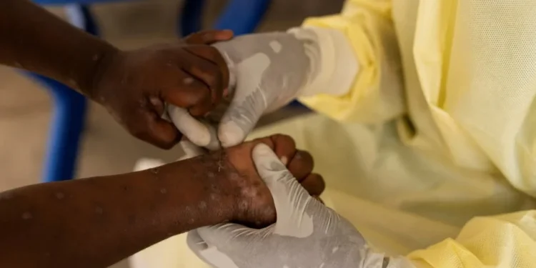 Mpox e politraumatismo lideram buscas “o que é” no Google; veja lista