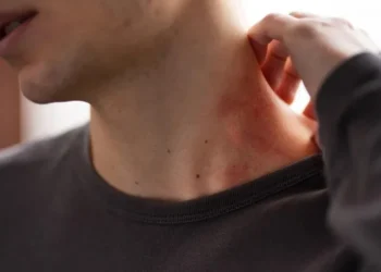 Médicos explicam possíveis riscos de picadas de percevejo • Freepik