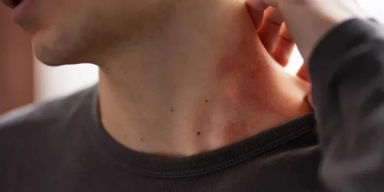 Picada de percevejo faz mal? Veja sintomas e como cuidar