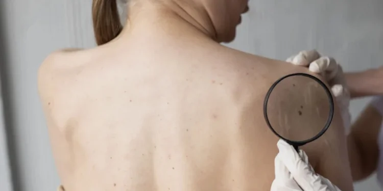 Câncer de pele: como saber quais manchas podem ser perigosas?