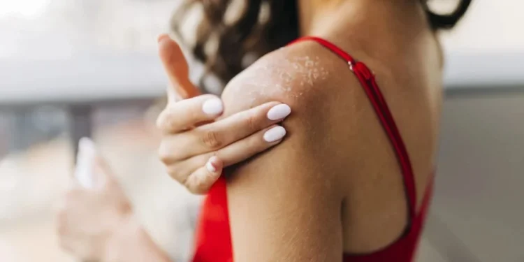 Doenças de pele são frequentes no verão devido a maior exposição solar e a alta umidade do ar • Eleganza/GettyImages