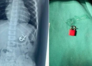 Criança engole cadeado com as chaves e passa por endoscopia para remoção • Dra. Thaís Sampaio