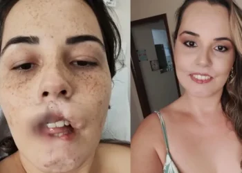 A influencer iniciou seu processo de reconstrução labial em dezembro de 2023 • Reprodução