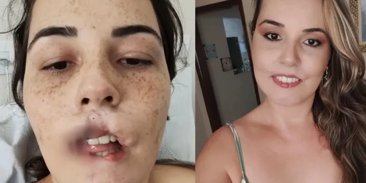 Influencer que perdeu os lábios em 2020 mostra a reconstrução de rosto