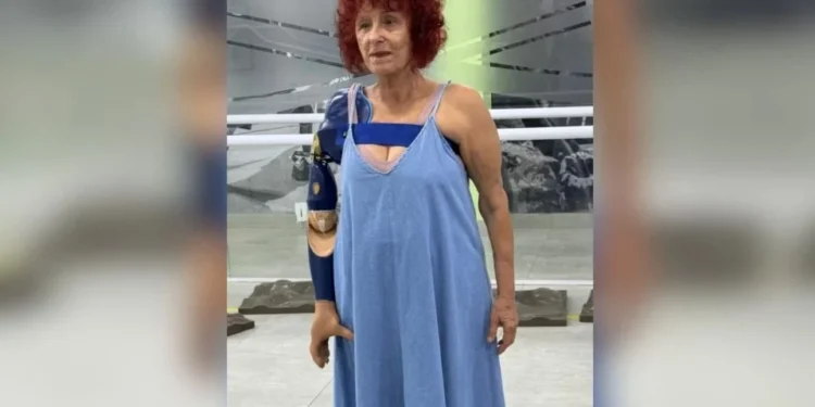 Escritora atacada por pitbulls no RJ recebe prótese biônica no braço